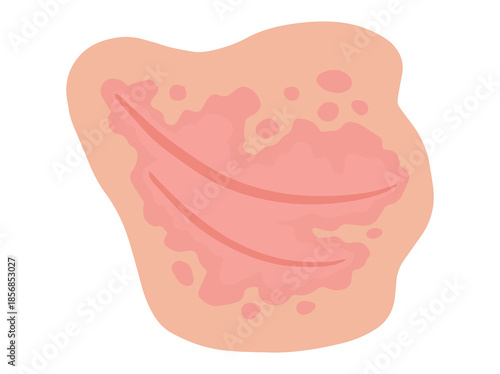 Inverse Psoriasis Disease in Skin