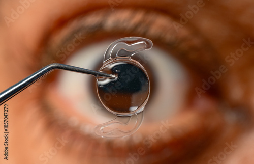 Fotografie Foldable intraocular lens positioned before human eye in surgery