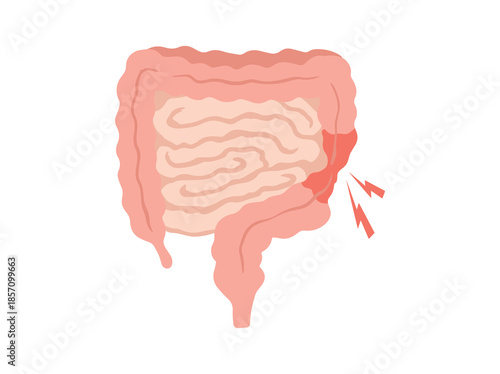 Irritable Bowel Syndrome IBS in Intestines Illustration
