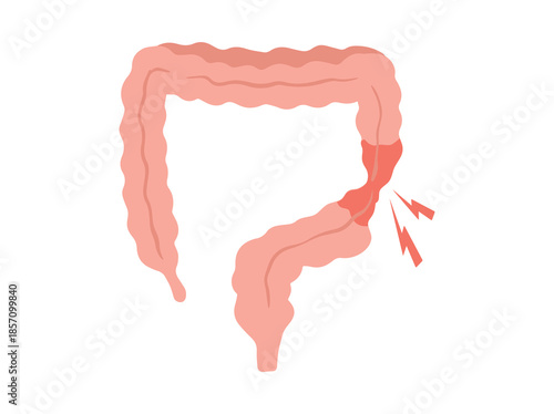 Hand Drawn Irritable Bowel Syndrome IBS in Intestines
