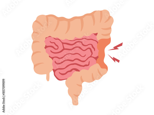 Irritable Bowel Syndrome IBS in Intestines