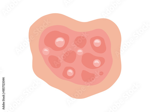 Hand Drawn Pustular Psoriasis Disease in Skin
