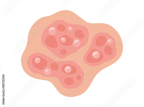 Hand Drawn Pustular Psoriasis Disease in Skin
