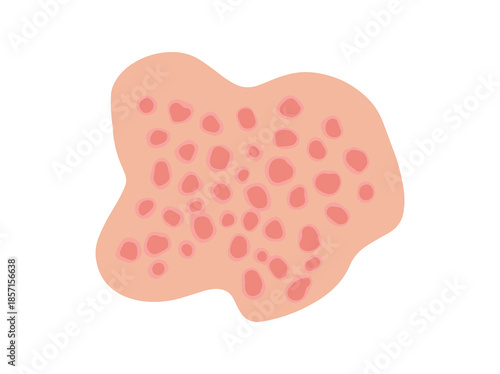 Hand Drawn Guttate Psoriasis Disease
