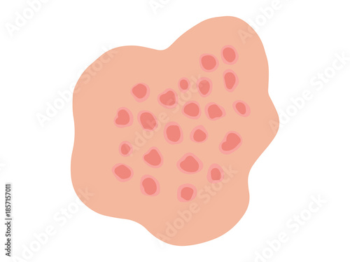 Guttate Psoriasis Disease Clip Art
