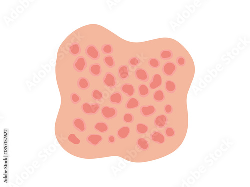 Guttate Psoriasis Disease in Skin
