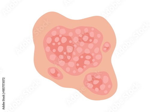 Hand Drawn Plaque Psoriasis Disease
