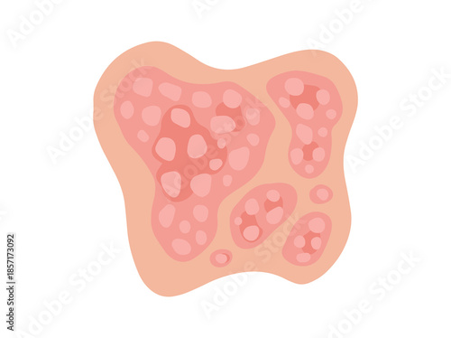 Plaque Psoriasis Disease Clip Art
