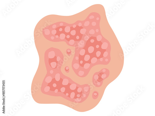 Plaque Psoriasis Disease in Skin
