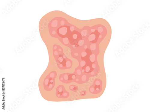 Plaque Psoriasis Disease in Skin
