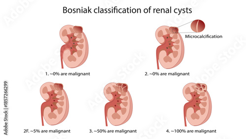 Bosniak classification of renal cysts