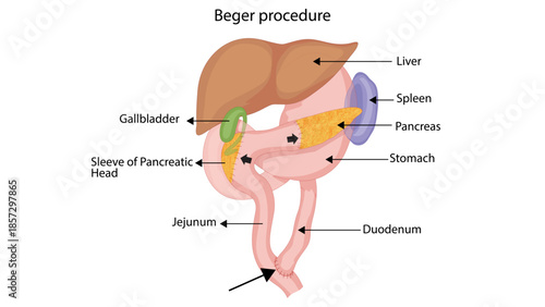 Beger procedure
The Beger procedure is a duodenum-preserving pancreatic head resection performed mainly for chronic pancreatitis.