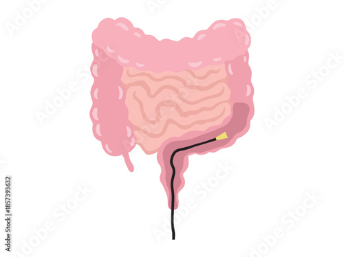 Sigmoidoscopy or Colonoscopy in Intestines

