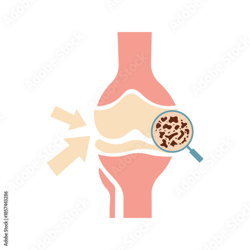 Osteoporosis Illustration