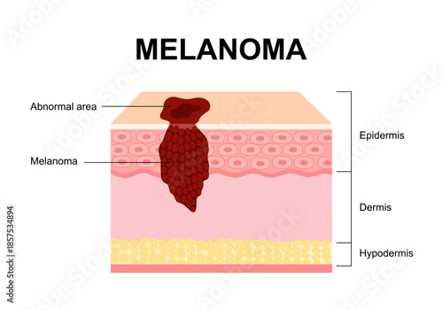 Melanoma skin cancer with a focus on melanocyte and skin layers including the epidermis and dermis structure diagram vector illustration.