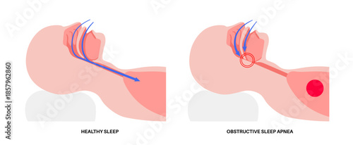 Obstructive sleep apnea