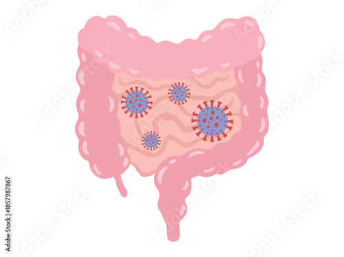 Intestinal Infection Disease in Colon or Intestines
