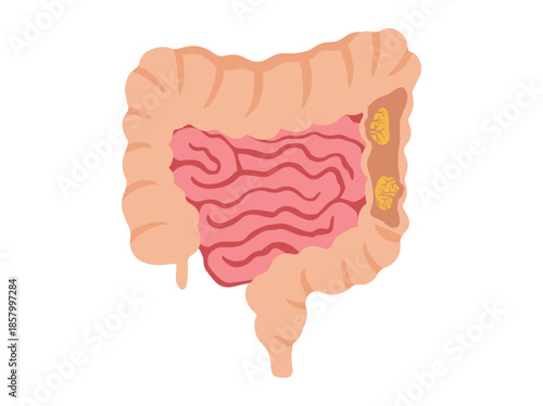 Colorectal Cancer in Intestines Illustration

