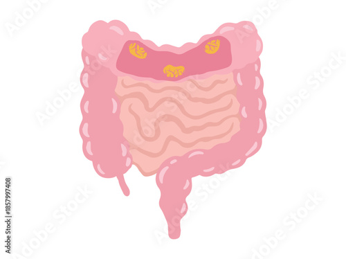 Colorectal Cancer in Intestinal Colon 
