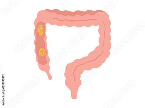 Colorectal Cancer in Intestinal Colon 
