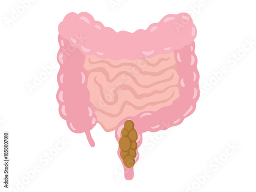 Constipation Disease in Intestinal Illustration
