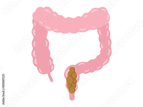 Constipation Disease in Intestinal Colon 
