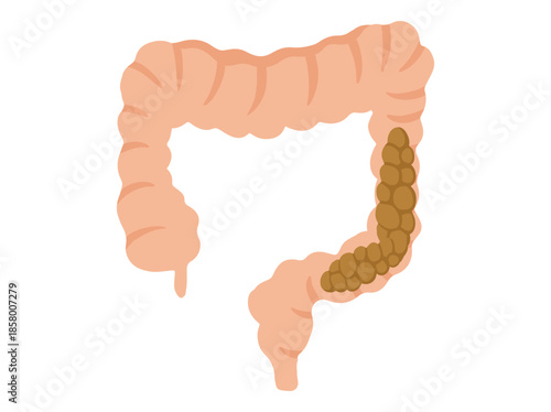 Hand Drawn Constipation Disease in Intestinal
