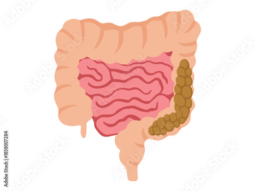 Constipation Disease in Intestinal Colon 
