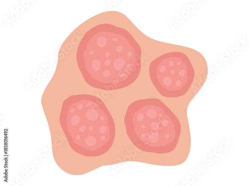 Nummular Eczema Disease Clip Art
