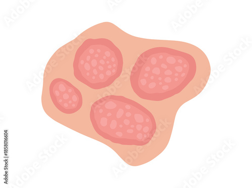 Nummular Eczema Disease in Skin
