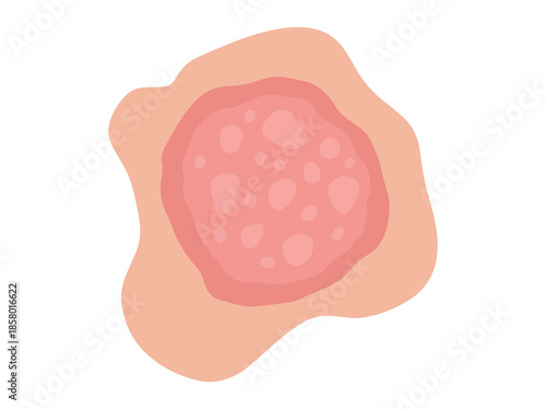 Hand Drawn Nummular Eczema Disease
