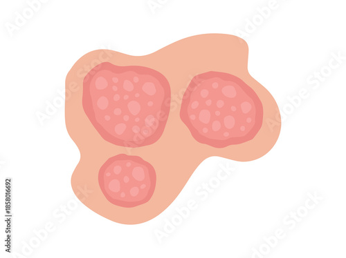 Nummular Eczema Disease in Skin
