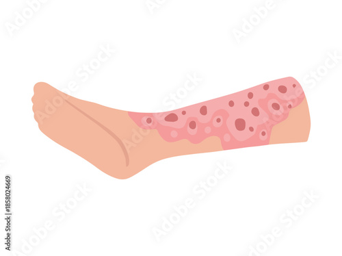 Neurodermatitis Disease Clip Art Illustration
