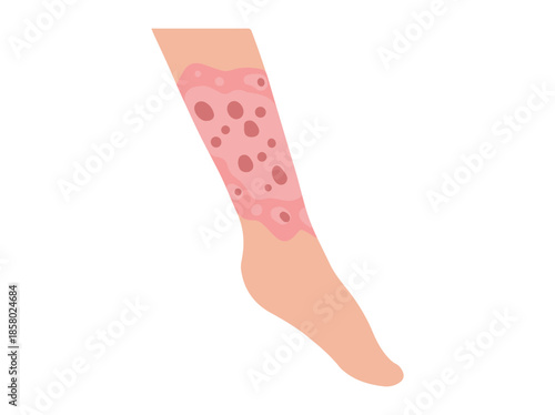 Neurodermatitis Disease in Foot Skin
