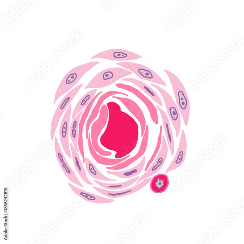 Illustration of squamous cell carcinoma, showing keratin pearl and dyskeratotic cell.