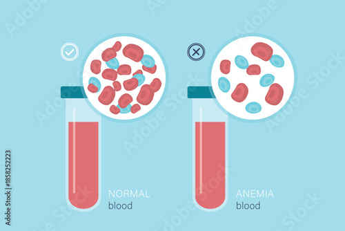 Normal blood and specimen with anemia disease. Human blood cells structure. Thrombocytes, leukocytes and erythrocytes under microscope. Microbiology test