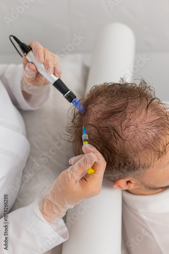 Alopecia. Man hair loss improve growth treatment regeneration, dermapen microneedling, vitamin exosomes plasma serum syringe injections. Trichologist doctor head scalp procedure fractional mesotherapy