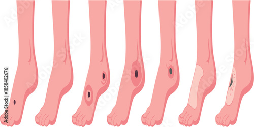 Stages of Skin Lesion and Mole Progression on Human Foot for Medical Awareness Illustration.