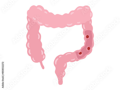 Intestinal Polyps Disease Illustration
