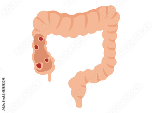 Intestinal Polyps Disease Clip Art

