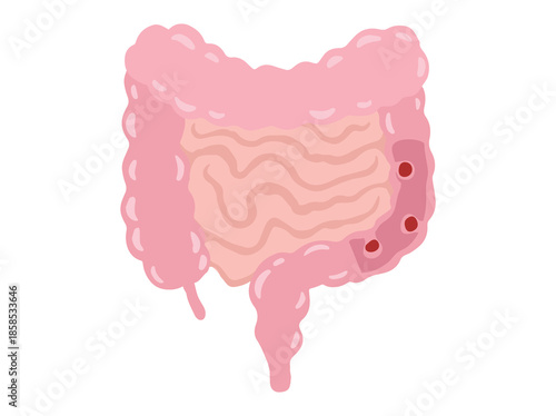 Intestinal Polyps Disease Illustration
