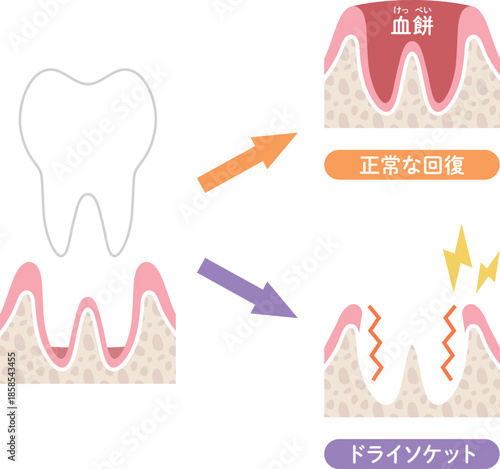 抜歯後の正常な回復とドライソケット