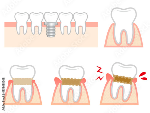 歯周病の歯茎と歯のイラスト素材セット3
