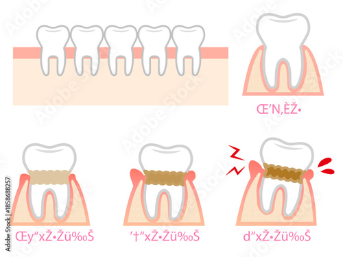 歯周病の歯茎と歯のイラスト素材セット4