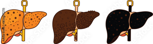 Human Liver Disease Stages Illustration Showing Healthy Fatty Cirrhosis Comparison Medical Flat Vector on White Background