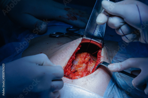 Εκτύπωση καμβά Surgical procedure: surgeons performing abdominal umbilical hernia surgery in op