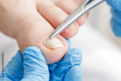 фотографія Closeup of podiatrist performing ingrown toenail treatment, white background