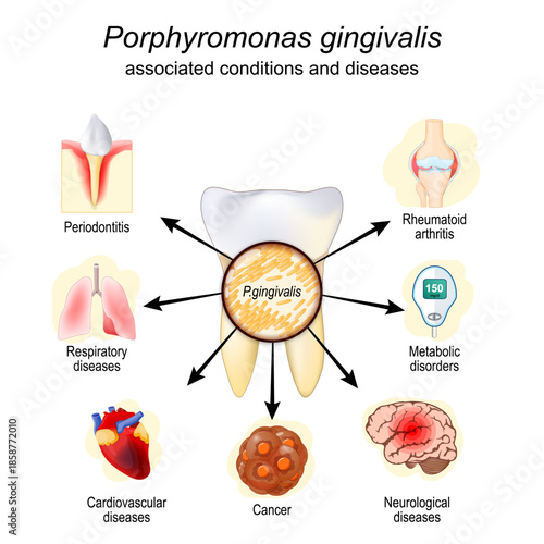 Bacteria Porphyromonas gingivalis and associated conditions or diseases. vector 