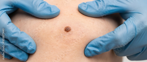 Wallpaper Mural Dermatologist Examining Suspicious Mole During Professional Skin Cancer Screening with Protective Gloves Torontodigital.ca