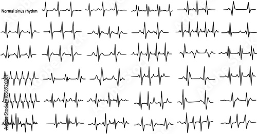 Electrocardiogram ECG Tracing Normal Sinus Rhythm Medical Line Art Vector Illustration